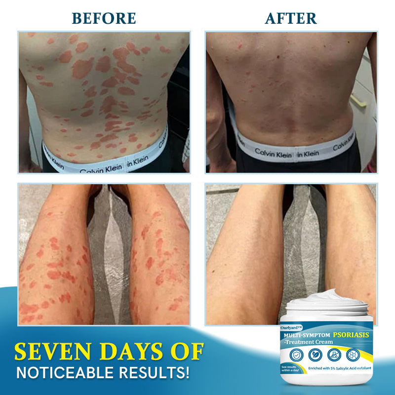 Ourlyard™ Multi-Symptom Psoriasis Treatment Cream👨‍⚕Doctor's Recommendation